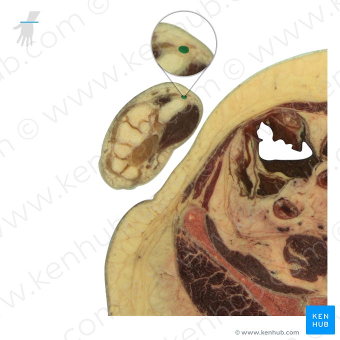 Tendon of abductor pollicis longus muscle (Tendo musculi abductoris pollicis longi); Image: National Library of Medicine