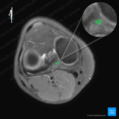 Ligamento cruzado posterior (Ligamentum cruciatum posterius); Imagen: 