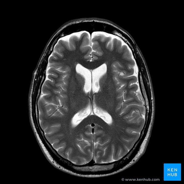 Brain MRI