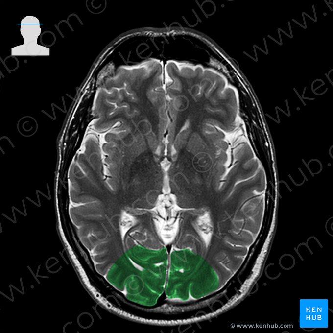 Lóbulo occipital (Lobus occipitalis); Imagen: 