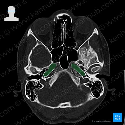 Carotid canal (Canalis caroticus); Image: 