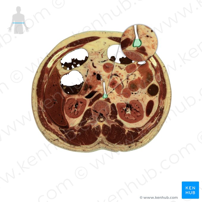 Aorta abdominalis (Bauchaorta); Bild: National Library of Medicine