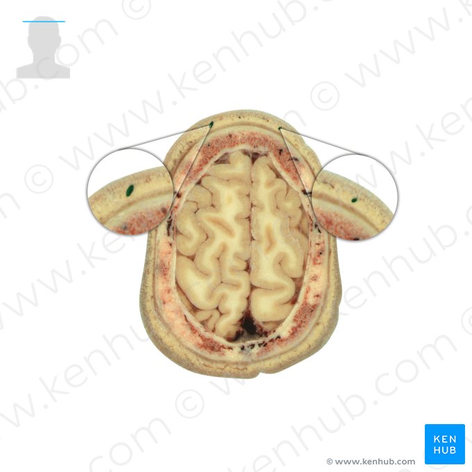 Supraorbital vein (Vena supraorbitalis); Image: National Library of Medicine