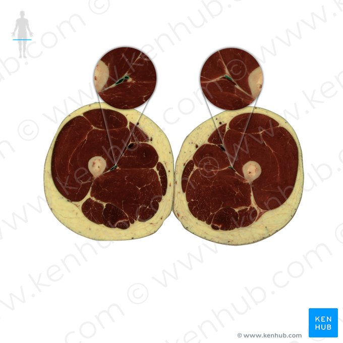 Veia femoral profunda (Vena profunda femoris); Imagem: National Library of Medicine