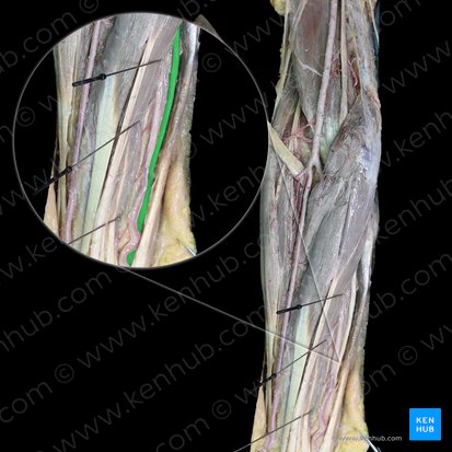 Nerf ulnaire (Nervus ulnaris); Image : 