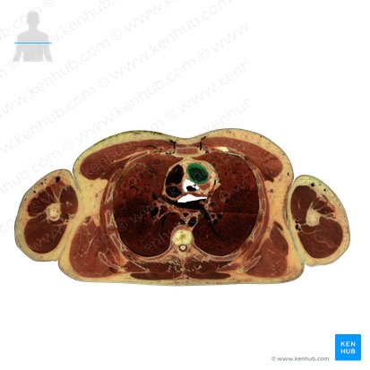 Ventrículo direito do coração (Ventriculus dexter cordis); Imagem: National Library of Medicine