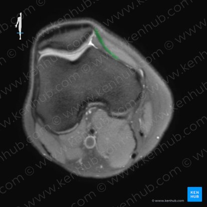 Retinaculum patellae mediale (Innerer Kniescheibenzügel); Bild: 