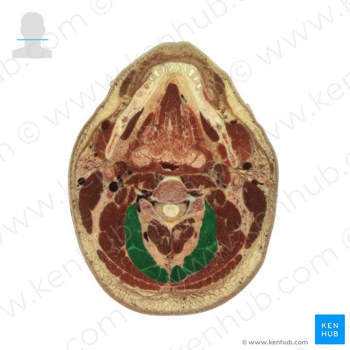 Semispinalis capitis muscle (Musculus semispinalis capitis); Image: National Library of Medicine