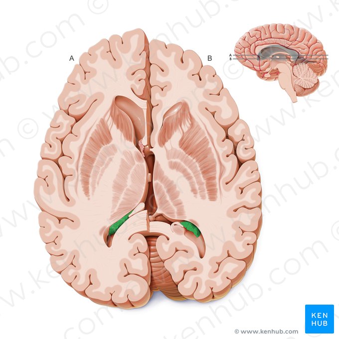 Plexo coroideo del ventrículo lateral (Plexus choroideus ventriculi lateralis); Imagen: Paul Kim