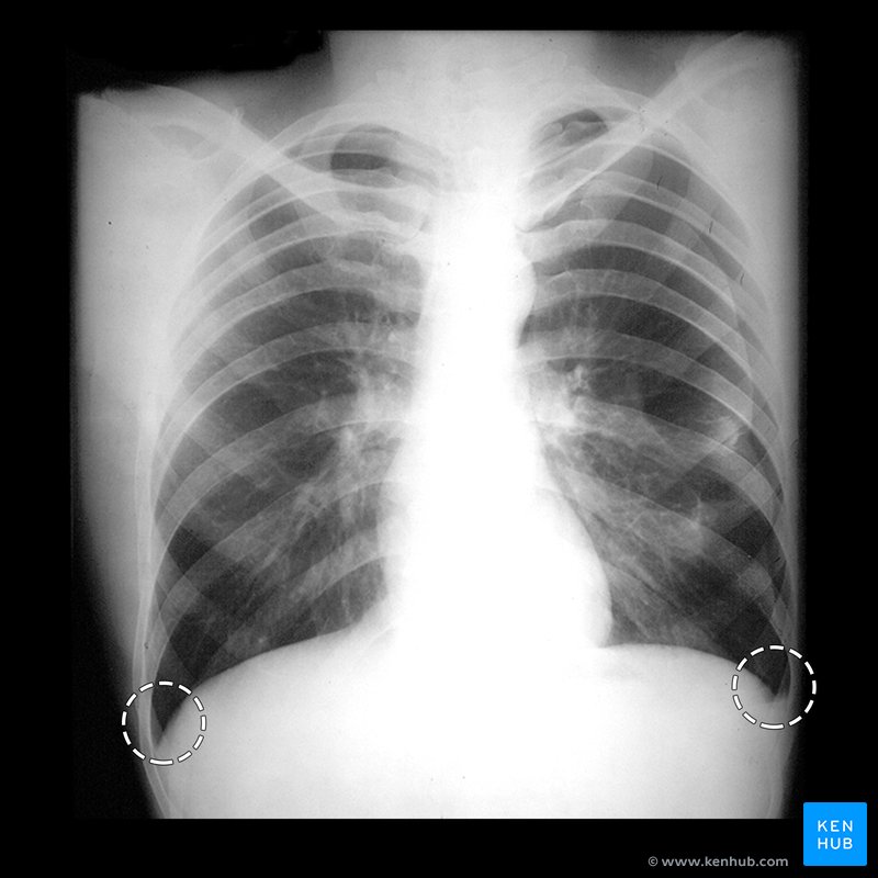 Left pleural effusion