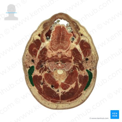 Musculus sternocleidomastoideus (Kopfwender); Bild: National Library of Medicine