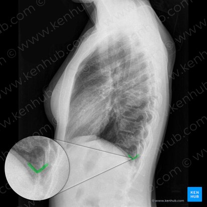 Angulus costophrenicus posterior sinister (Linker hinterer Zwerchfellrippenwinkel); Bild: 