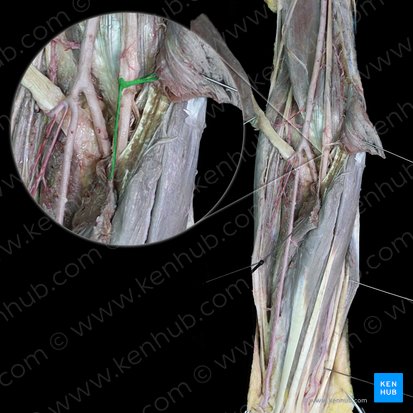 Rameaux musculaires du nerf médian pour le muscle rond pronateur (Rami musculares nervi mediani cum musculus pronator teres); Image : 