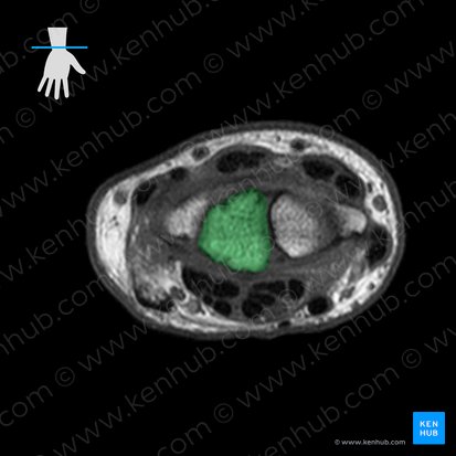 Lunate bone (Os lunatum); Image: 