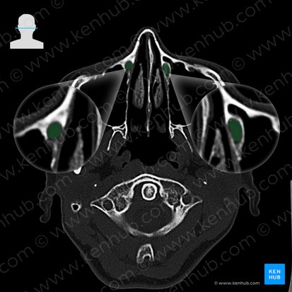 Nasolacrimal duct (Ductus nasolacrimalis); Image: 