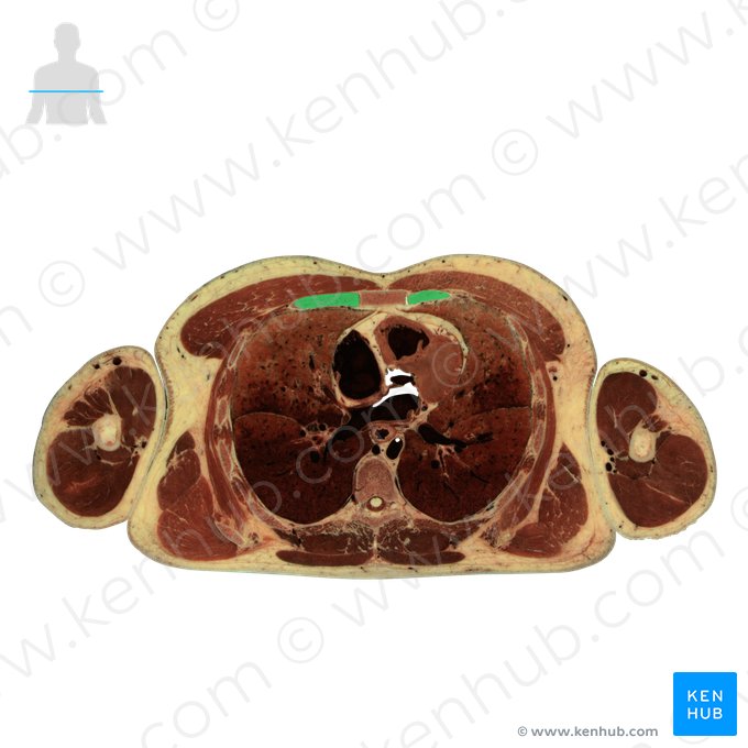 Cartilago costalis costae 3 (Knorpel der 3. Rippe); Bild: National Library of Medicine