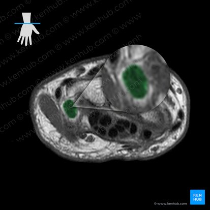 Ligamentum pisometacarpeum (Erbsenbein-Mittelhandknochen-Band); Bild: 