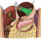 Ligamento hepatoduodenal