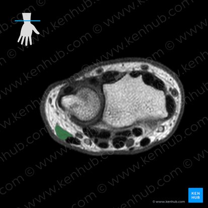 Músculo flexor ulnar do carpo (Musculus flexor carpi ulnaris); Imagem: 