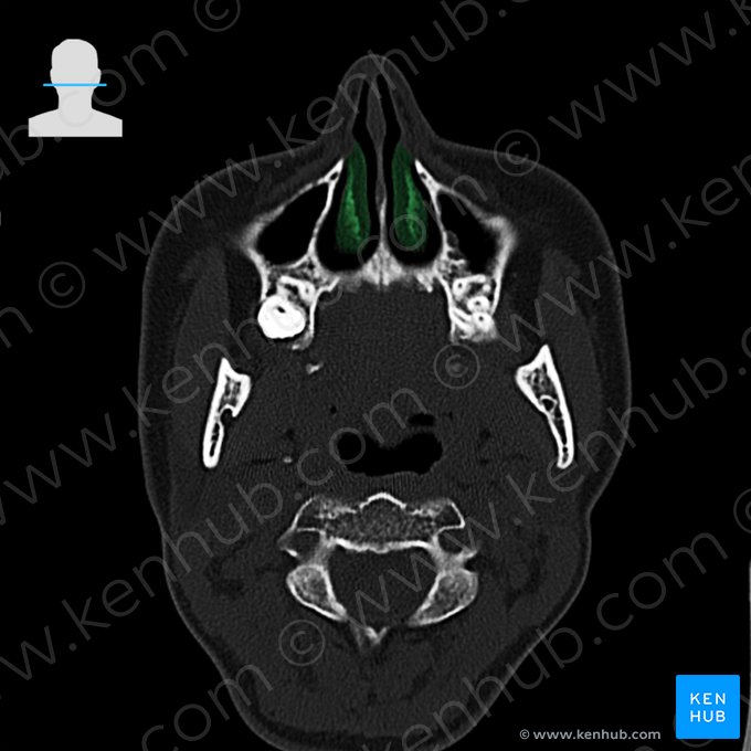 Cornete nasal inferior (Concha nasalis inferior); Imagen: 