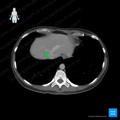 Right hepatic vein (Vena hepatica dextra); Image: 