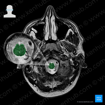 Bulbo raquídeo (Medulla oblongata); Imagen: 