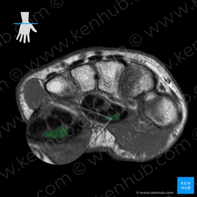 Nervo mediano (Nervus medianus); Imagem: 