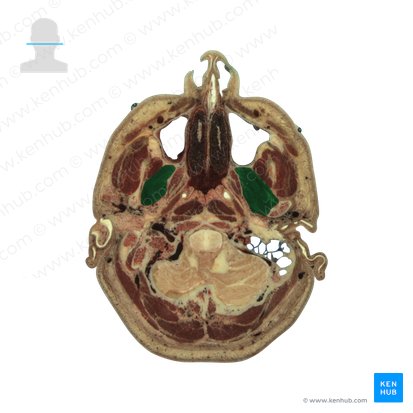 Lateral pterygoid muscle (Musculus pterygoideus lateralis); Image: National Library of Medicine