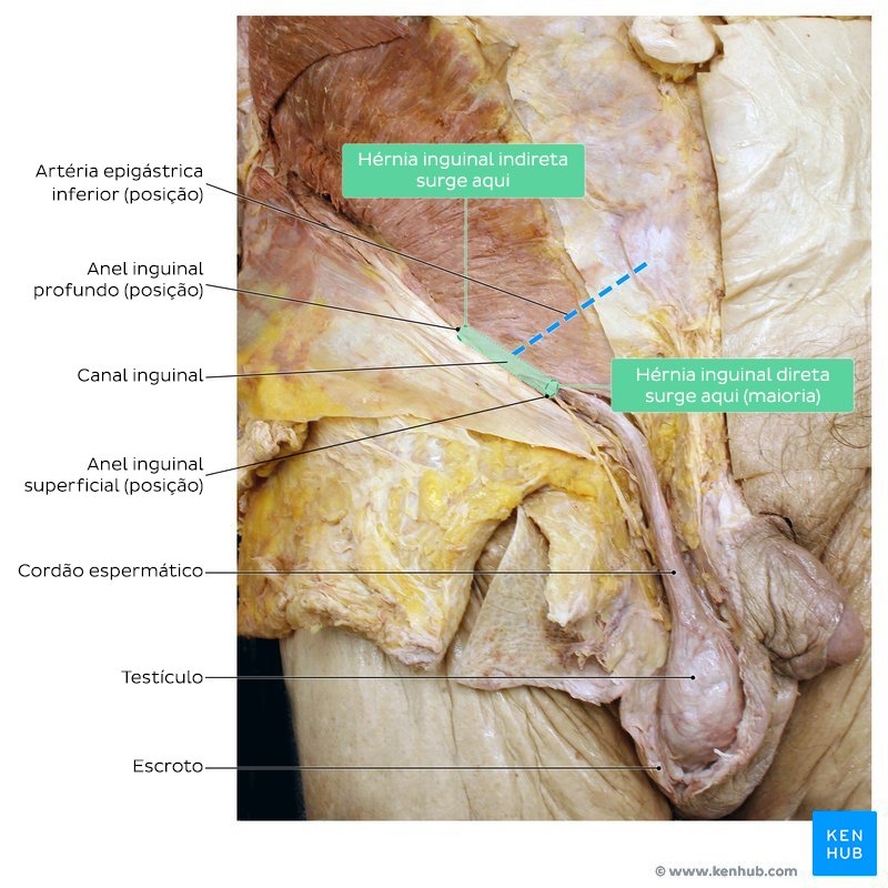 Canal inguinal em dissecção anatômica post mortem