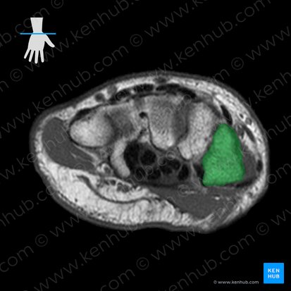 Trapezium bone (Os trapezium); Image: 