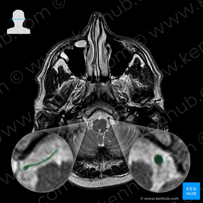 Vertebral artery (Arteria vertebralis); Image: 