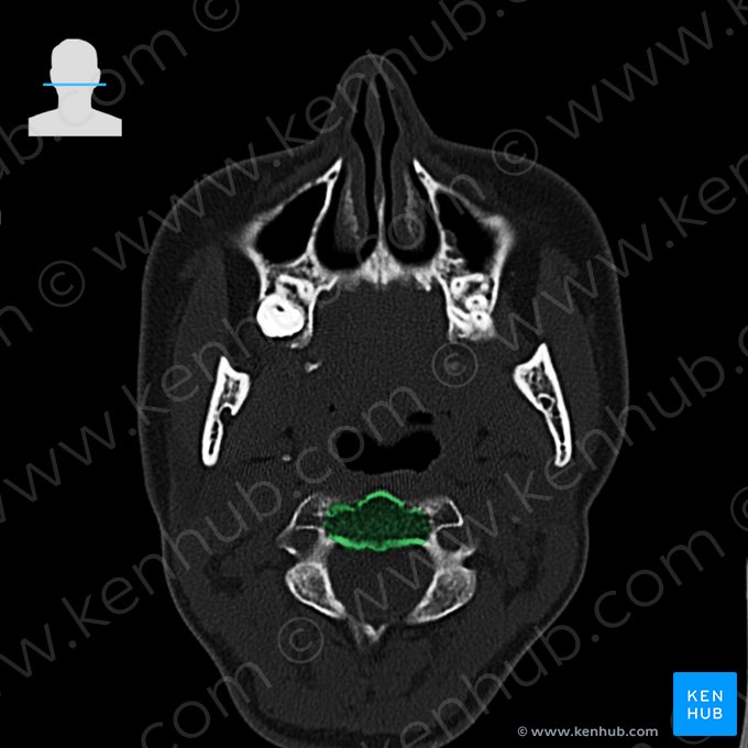 Cuerpo vertebral del axis (Corpus vertebrae axis); Imagen: 