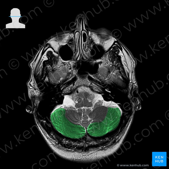 Lóbulo semilunar inferior (Lobulus semilunaris inferior); Imagem: 