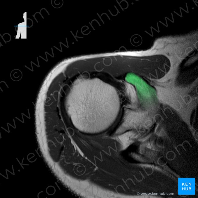 Proceso coracoides de la escápula (Processus coracoideus scapulae); Imagen: 