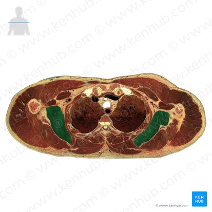 Subscapularis muscle (Musculus subscapularis); Image: National Library of Medicine