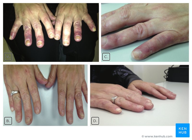 Fingertip cyanosis and ulcer - Raynaud's phenomenon