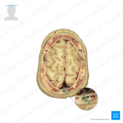 Sagittal suture (Sutura sagittalis); Image: National Library of Medicine