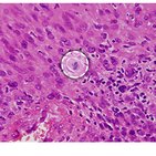 Clinical case: Malignancy along facial nerve