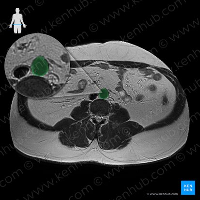 Aorta abdominal (Aorta abdominalis); Imagem: 