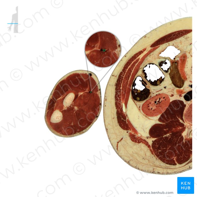 Artéria radial (Arteria radialis); Imagem: National Library of Medicine