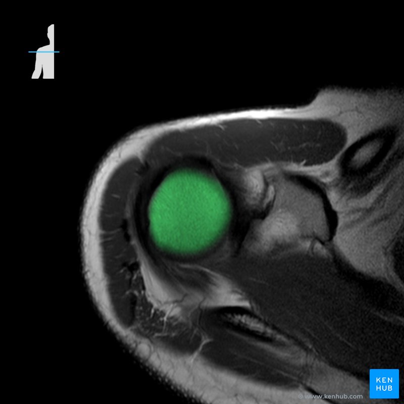 Humeruskopf (Caput humeri) - Radiologie