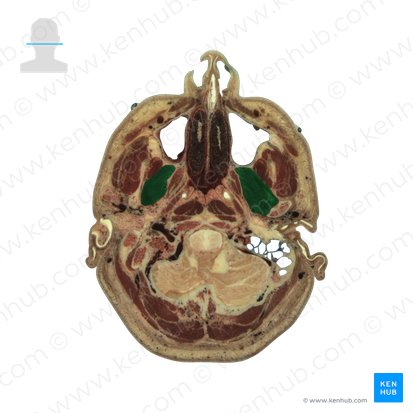 Músculo pterigoideo lateral (Musculus pterygoideus lateralis); Imagen: National Library of Medicine