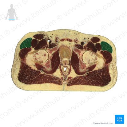 Musculus tensor fasciae latae (Schenkelbindenspanner); Bild: National Library of Medicine