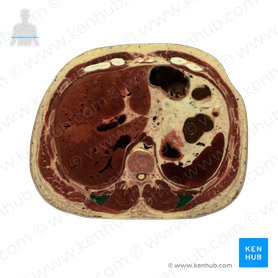 Musculus iliocostalis lumborum (Darmbein-Rippen-Muskel der Lende); Bild: National Library of Medicine
