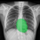 How to read a normal chest x ray: a step by step approach