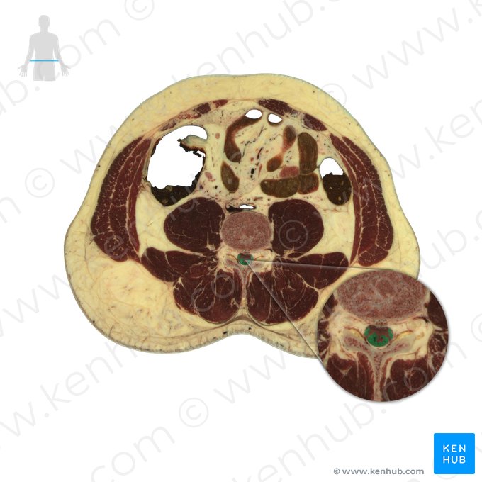 Cauda equina (Pferdeschwanz); Bild: National Library of Medicine