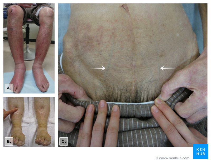 Pitting Edema & Distended Superficial Veins