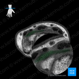Dorsal ulnocarpal ligament (Ligamentum ulnocarpeum dorsale); Image: 