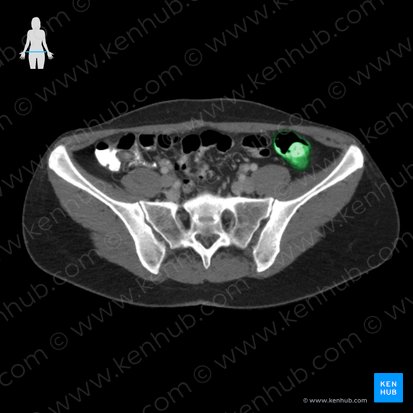 Descending colon (Colon descendens); Image: 