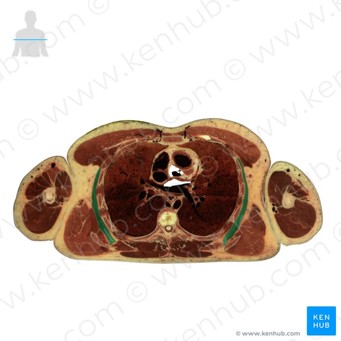 Musculus serratus anterior (Vorderer Sägemuskel); Bild: National Library of Medicine